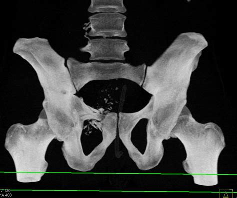 GSW with Superior Pubic Ramus Fracture and Bladder Injury - Trauma Case ...