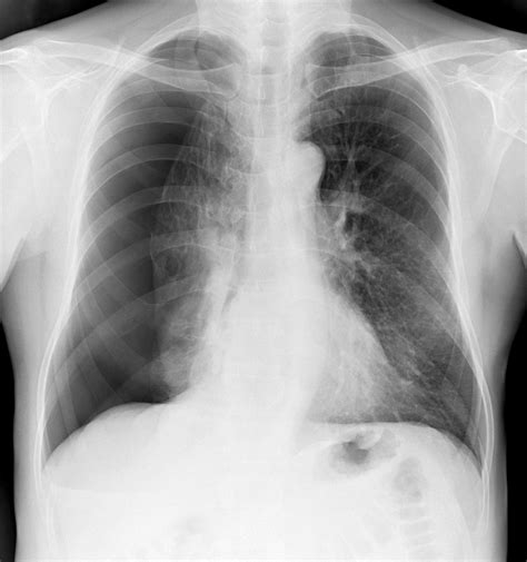 Atelectasis Chest X Ray