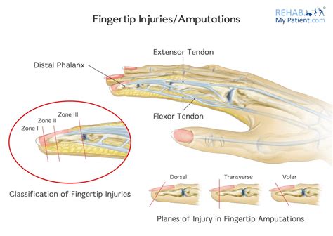 Emergency Room Presentation - Fingertip Injuries