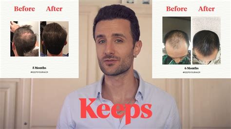 Keeps Hair Loss Review - YouTube