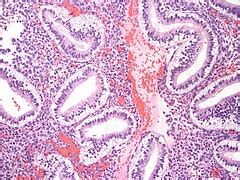 Secretory phase endometrium - Libre Pathology