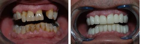 Puentes Dentales ÚLTIMOS Tipos de Puente - ODONTOLOGIA ESPECIALIZADA MEDELLIN