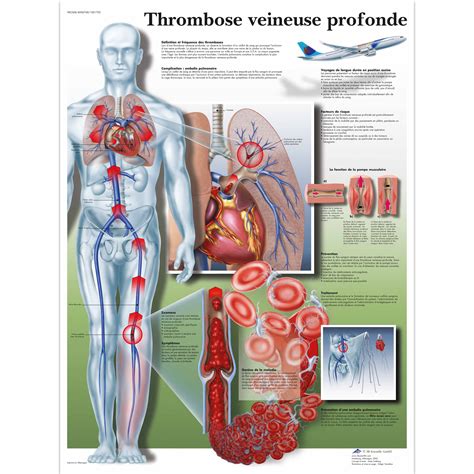 Thrombose veineuse profonde - 4006768 - VR2368UU - Cardiovascular System - 3B Scientific