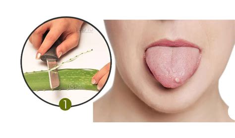 Home Remedies for Blisters on Tongue | Top 10 Home Remedies