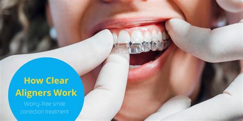 How Clear Aligners Work | MsDental