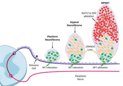 The clinical spectrum and genetic model of nerve tumor development in... | Download Scientific ...