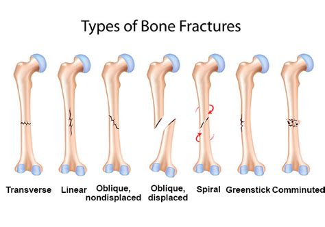 17 Different Types of Bone Fractures