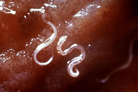 How To Detect Worms In Humans - Phaseisland17