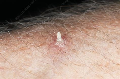 Cutaneous horn - Stock Image - C019/7886 - Science Photo Library