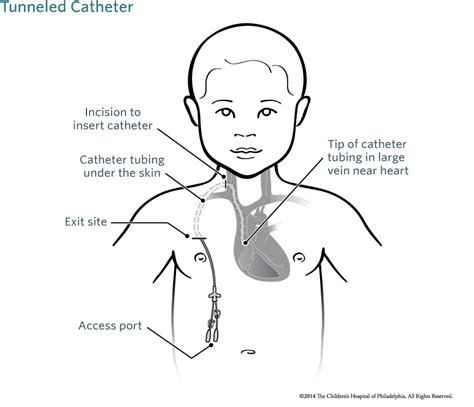 Tunneled Central Venous Catheter Placement