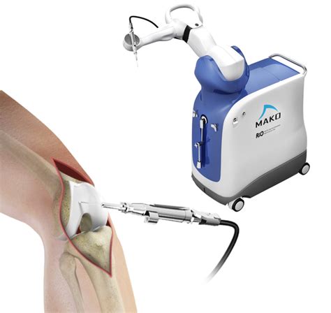 Robotic Assisted Knee Surgery Cincinnati, OH | MAKOplasty Kentucky, Ohio