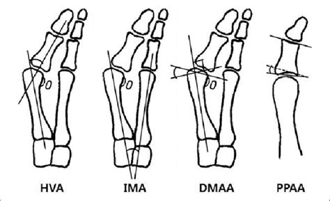 Radiographic parameter of the hallux valgus. DMAA, distal metatarsal... | Download Scientific ...