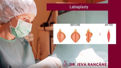 Intimate plastic surgery: labiaplasty - YouTube