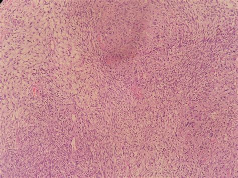 GLIOSARCOMA (ATLAS) – Histopathology.guru