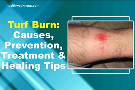 Turf Burn: Causes, Prevention, Treatment & Healing Tips 2024