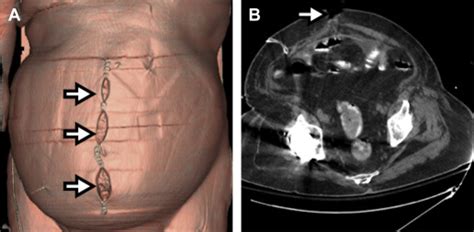 Imaging of Abdominal Postoperative Complications | Radiology Key