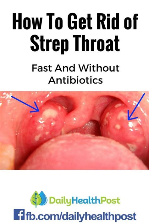 Best 25+ Signs of strep throat ideas on Pinterest | Strep throat signs ...