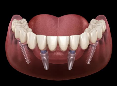 The History of All-on-4 Dental Implants - Advanced Family Dentistry ...