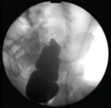 The Case Files: Sigmoid Volvulus in an Adolescent