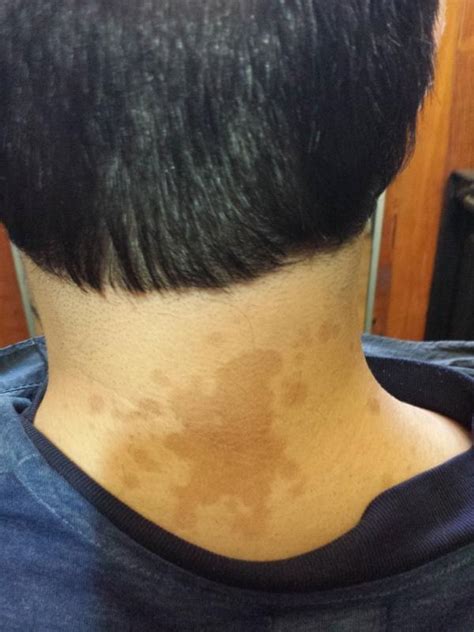 Dark spots - neck | Ask MetaFilter