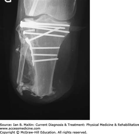 Lower Limb Amputation, Rehabilitation, & Prosthetic Restoration | Musculoskeletal Key