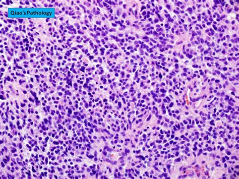 Qiao's Pathology: Glioblastoma Multiforme (GBM) | Microscopi… | Flickr