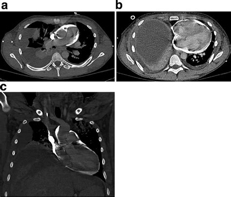 -CTA chest reveals small amount of contrast in the pulmonary artery and... | Download Scientific ...