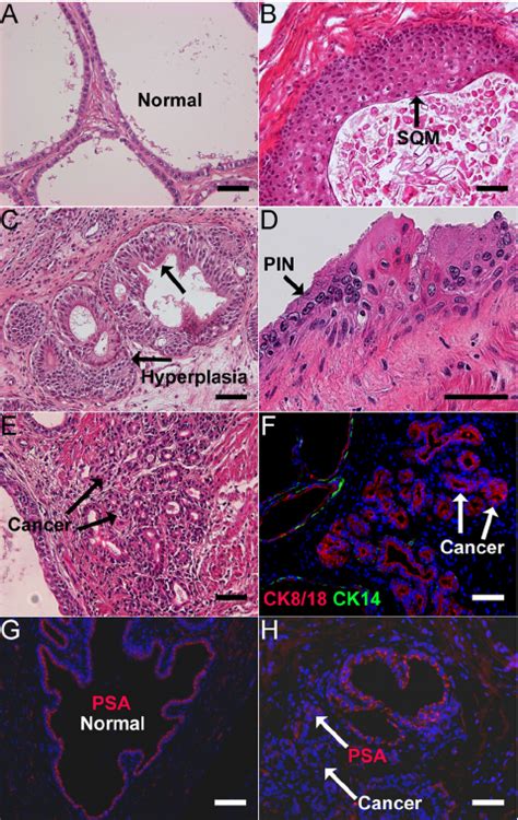 Hormonal carcinogenesis in human prostate epithelium of chimeric... | Download Scientific Diagram