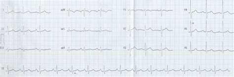 PQRST in ECG - Cardiophile