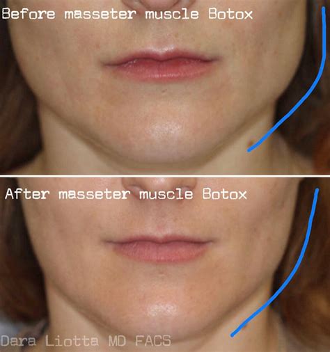 BOTOX® Cosmetic - New York City - Dr. Dara Liotta