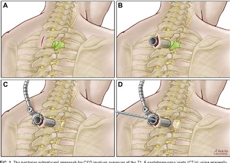 Figure 1 from Sympathectomy via a posterior approach after a failed ...