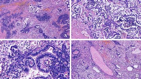 Histology of the mixed germ cell tumor. A) Low power photomicrograph ...