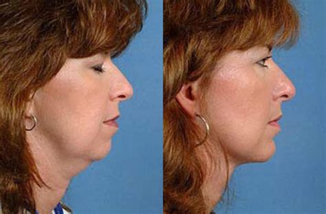 Neck Procedures Before & After Photo Gallery | Louisville, KY | CaloSpa ...