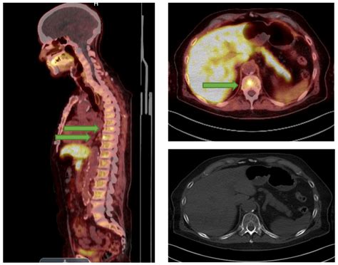 PET/CT For Prostate Cancer - Charter Radiology