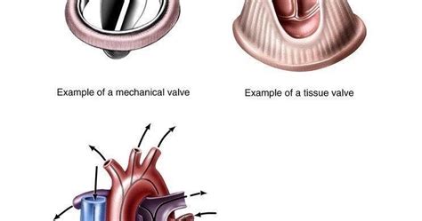 artificial heart valve