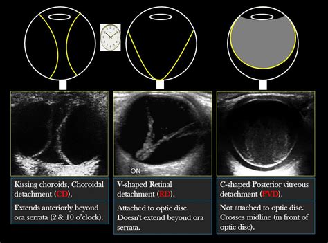 Types of Ocular detachments