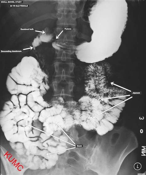 Small Bowel Series from KU Radiographic Anatomy | Radiology student, Radiology, Radiology schools