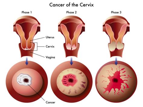 Cervical Cancer Symptoms and Signs | Cervical Cancer Prevention