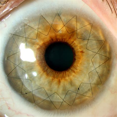 Surgical procedure of corneal transplantation