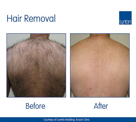 Laser Hair Removal · Professional Treatment · The Lynton Clinic