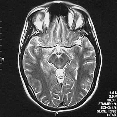 MRI, Axial T2 Weighted