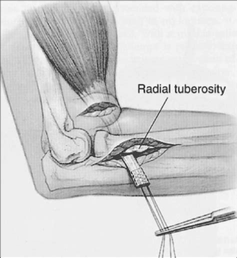 Distal Biceps Tendon Surgery