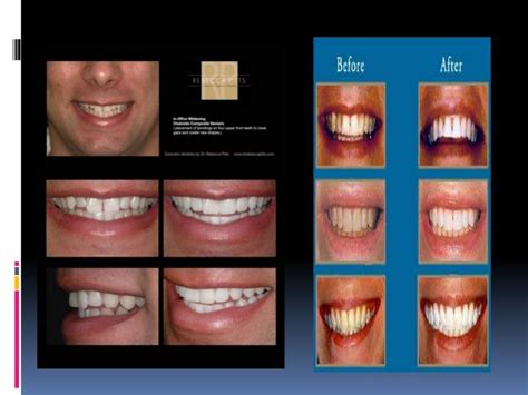 Types of veneers