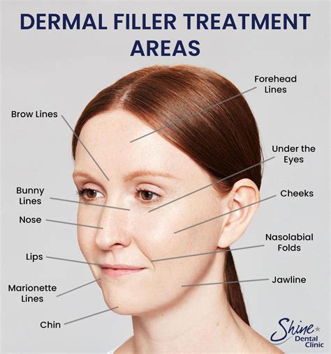 Dermal Fillers - Dentist Alton