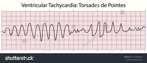 Ecg Ventricular Tachycardia Torsades De Pointes Stock Vector (Royalty Free) 2175282577 ...