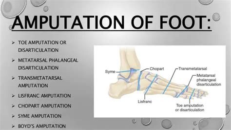 Tarsometatarsal Amputation