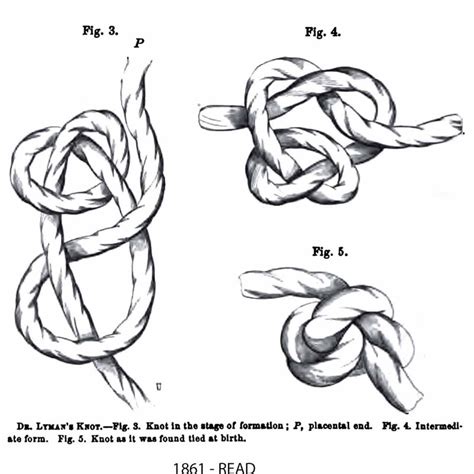 Umbilical Cord - History Of Midwifery, Obstetrics, Gynecology...