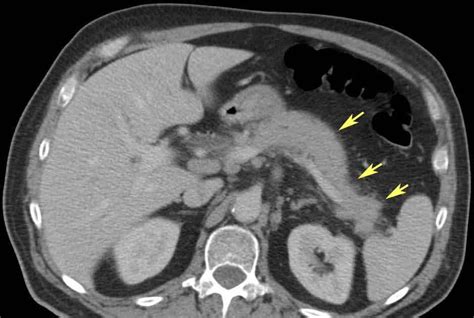 RiT radiology: Autoimmune Pancreatitis