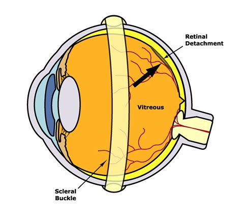 Scleral Buckle — THE RETINA INSTITUTE