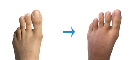 Before And After Foot Surgery - Image Gallery | London Foot & Ankle Surgery